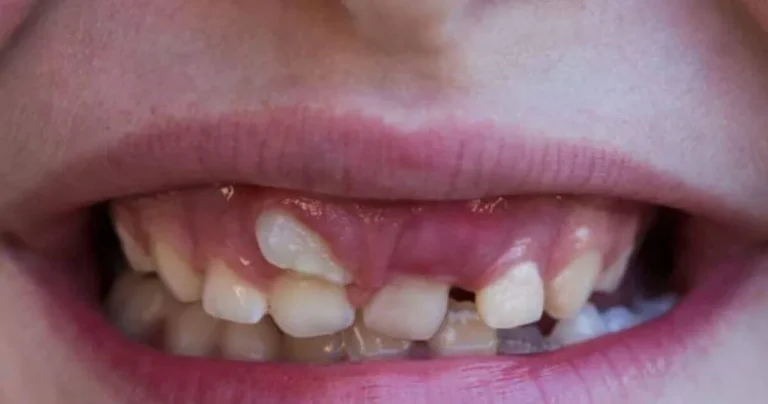 Tooth Growing Out Of Gum Child: Causes, Signs And Treatment