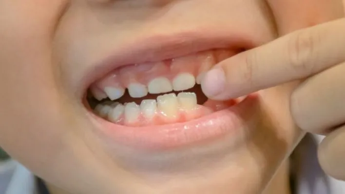 Space in baby teeth after teeth fall out