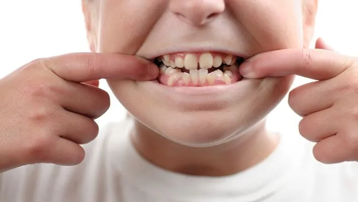 Close-up of a child's teeth showing misalignment, highlighting the problems associated with crooked baby teeth.