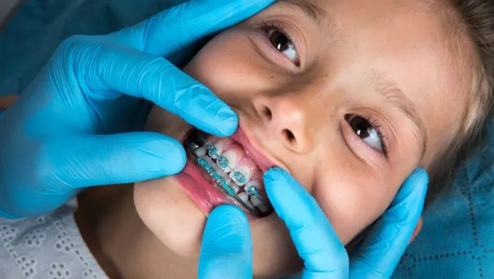 Dentist applying braces to a child's teeth as an intervention option for correcting crooked baby teeth.