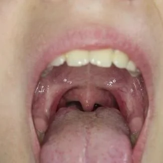 Submucosal (or Hidden) Tongue-Tie